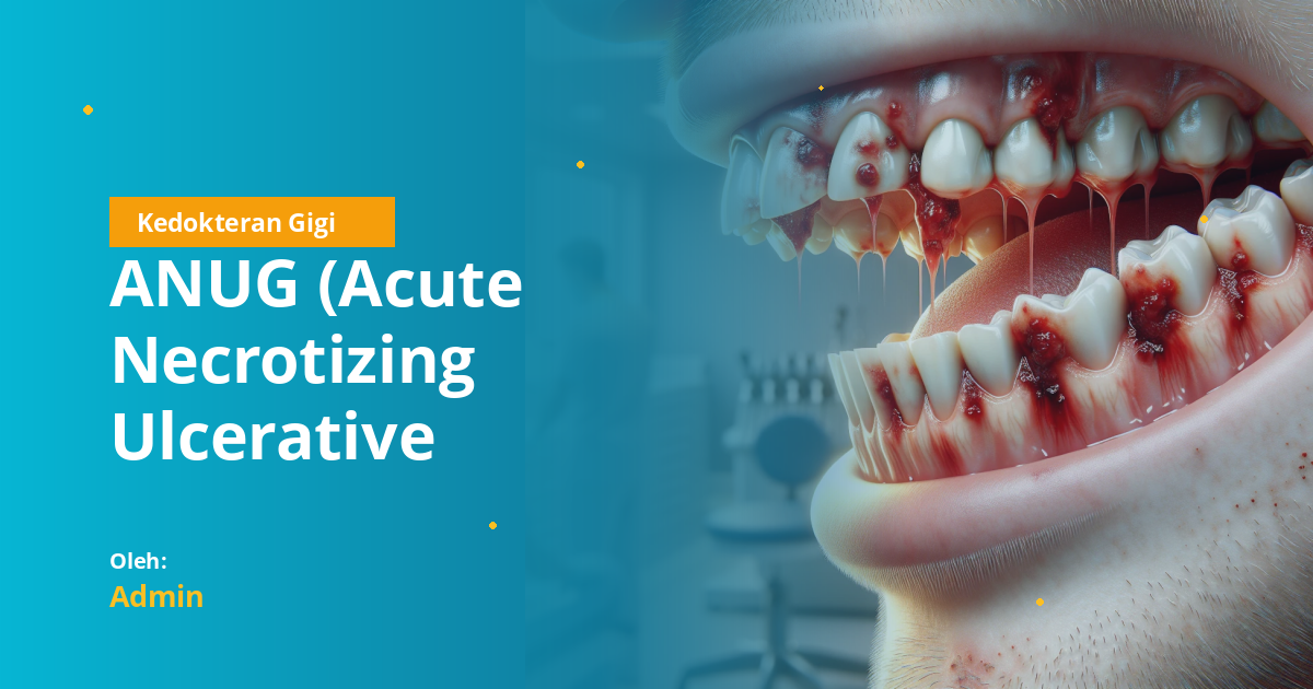 ANUG (Acute Necrotizing Ulcerative Gingivitis): Penyebab, Gejala, dan Penatalaksanaan untuk Mahasiswa Kedokteran Gigi