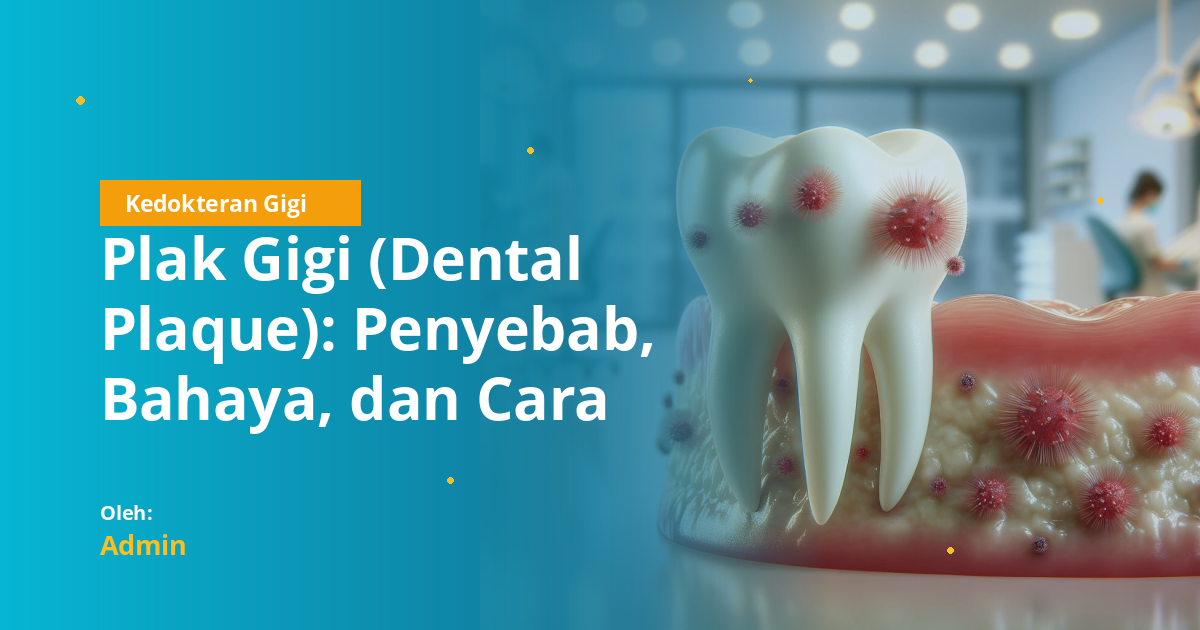 Plak Gigi (Dental Plaque): Penyebab, Bahaya, dan Cara Menghilangkan secara Efektif untuk Mahasiswa Kedokteran Gigi