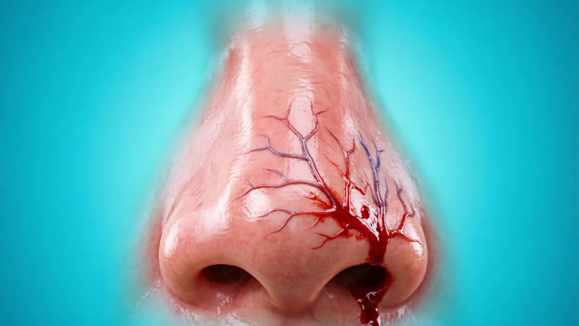 Epistaksis Anterior