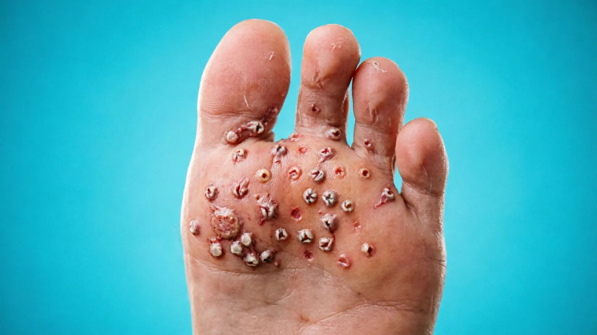 Pitted Keratolysis
