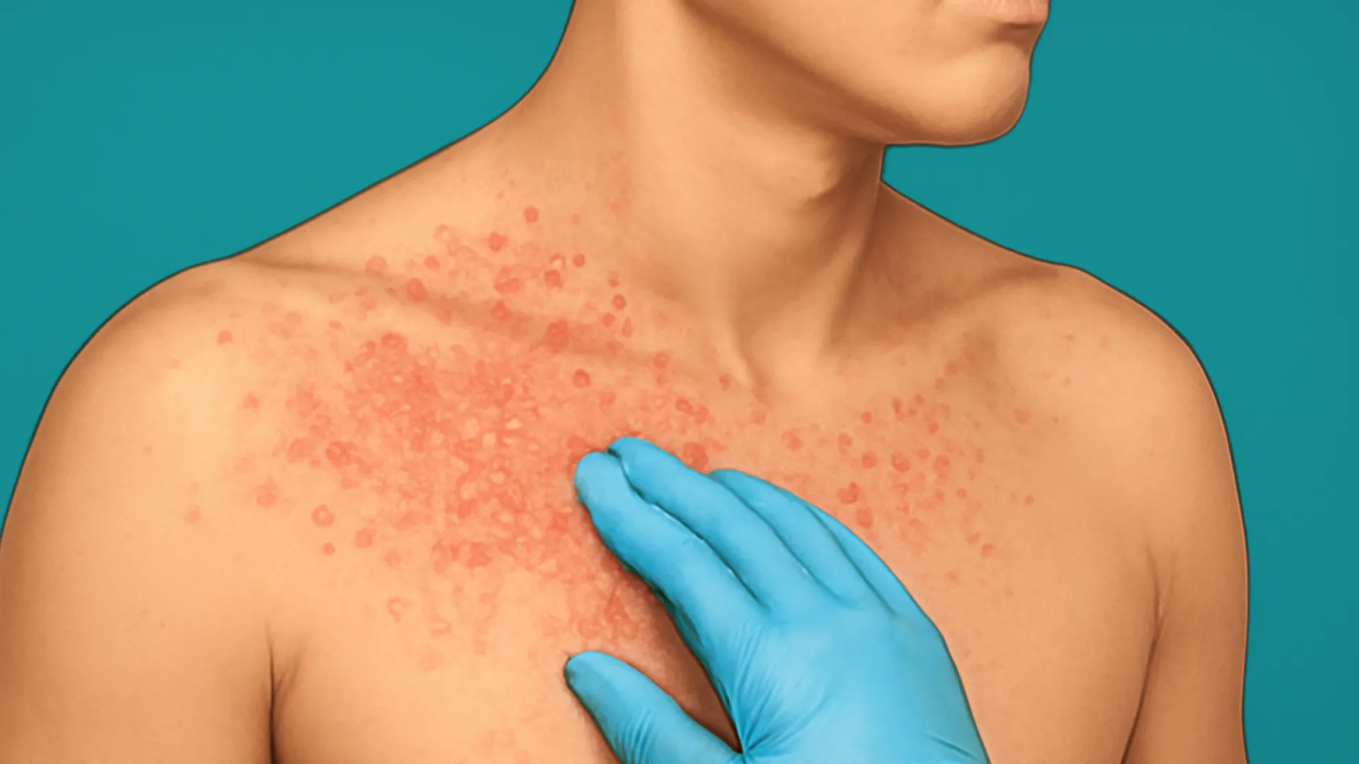 Miliaria / Hidradenitis