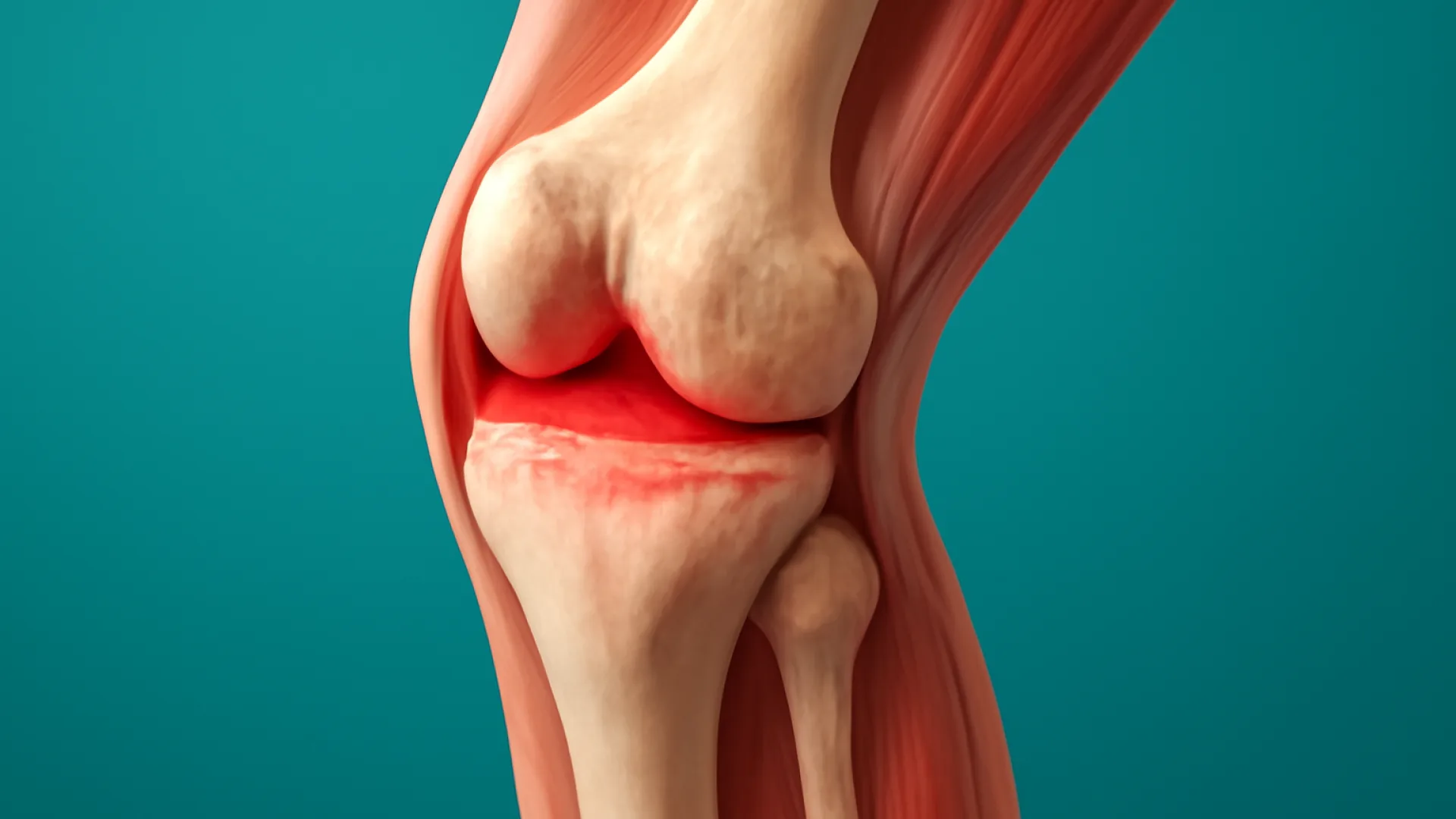 Arthritis (overview)