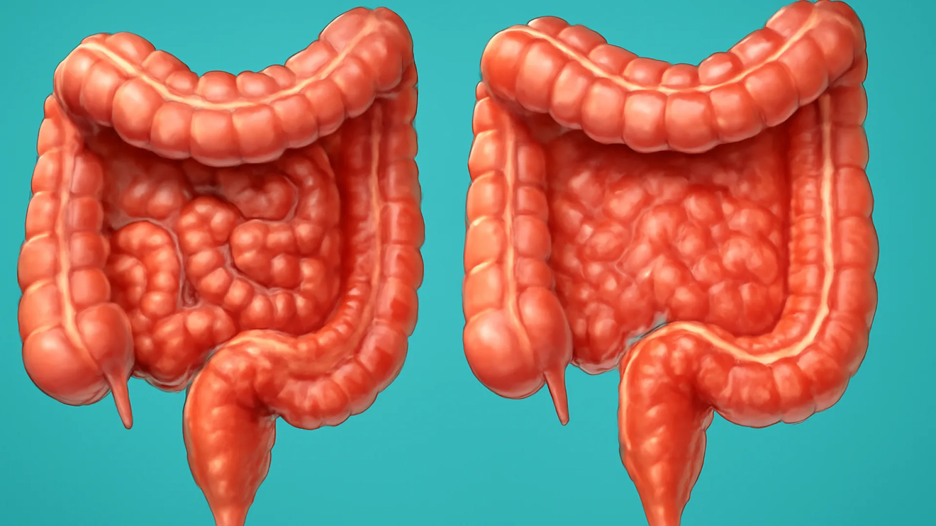 Tabel: IBD Crohn vs KU