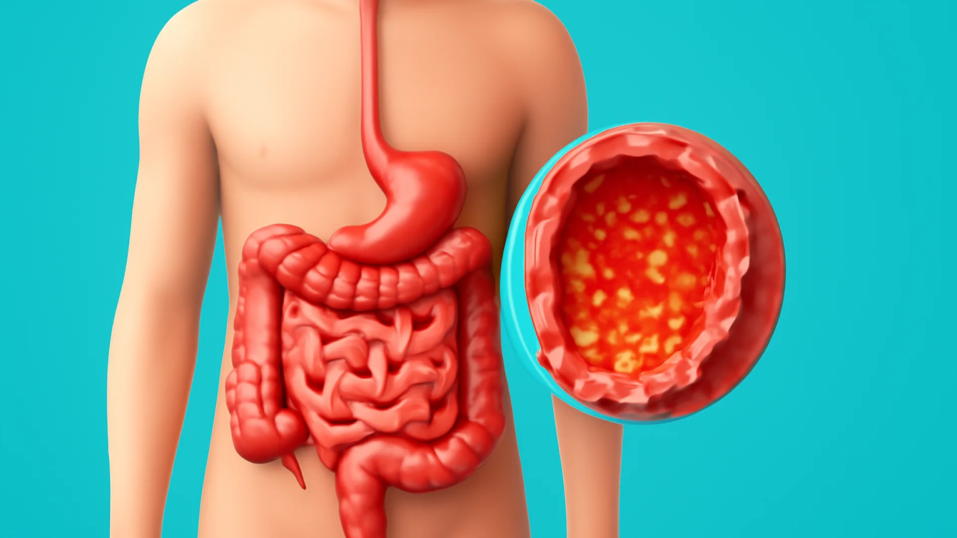 Gastroenteritis / Diare Infeksi